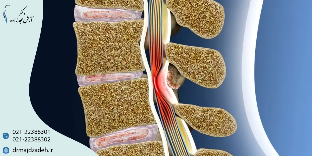 انواع تنگی کانال نخاع