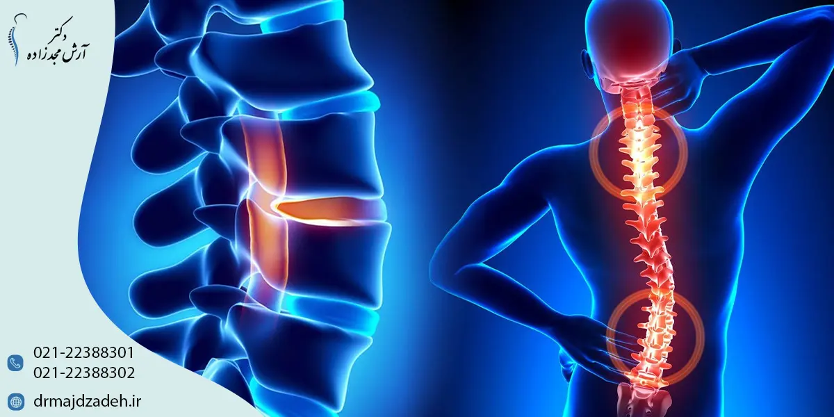 تنگی کانال نخاع چیست؟