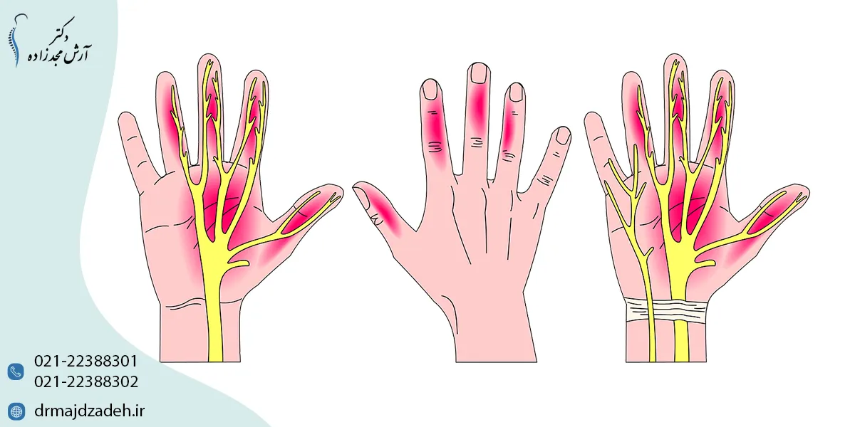 دلایل تنگ شدن کانال مچ دست