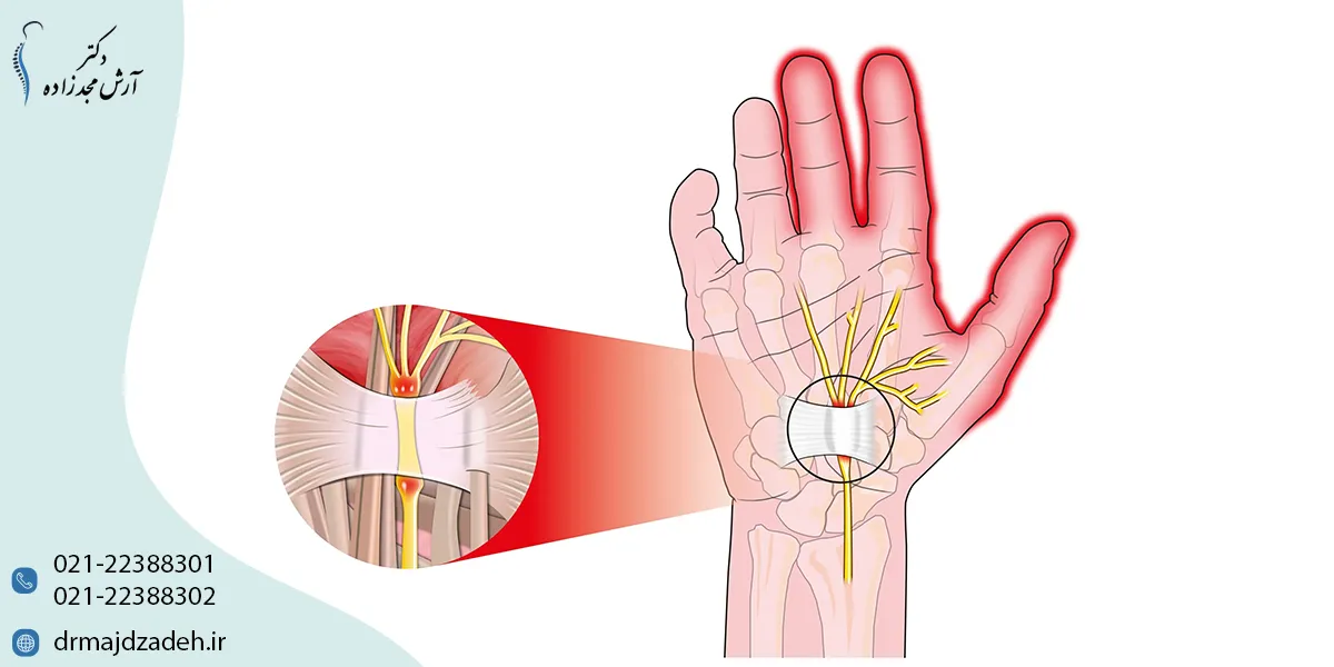 روش تشخیص تنگی کانال مچ دست یا همان سندرم تونل کارپال