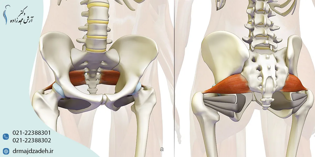 روش درمان piriformis syndrome