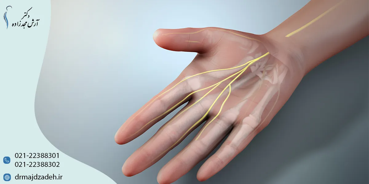 روشهای پیشگیری از سندرم تونل کارپال مچ دست