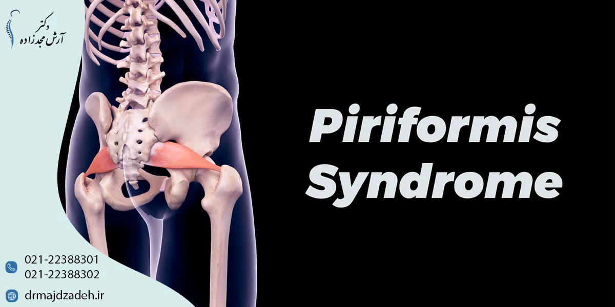 علائم سندرم پیریفورمیس (piriformis syndrome)