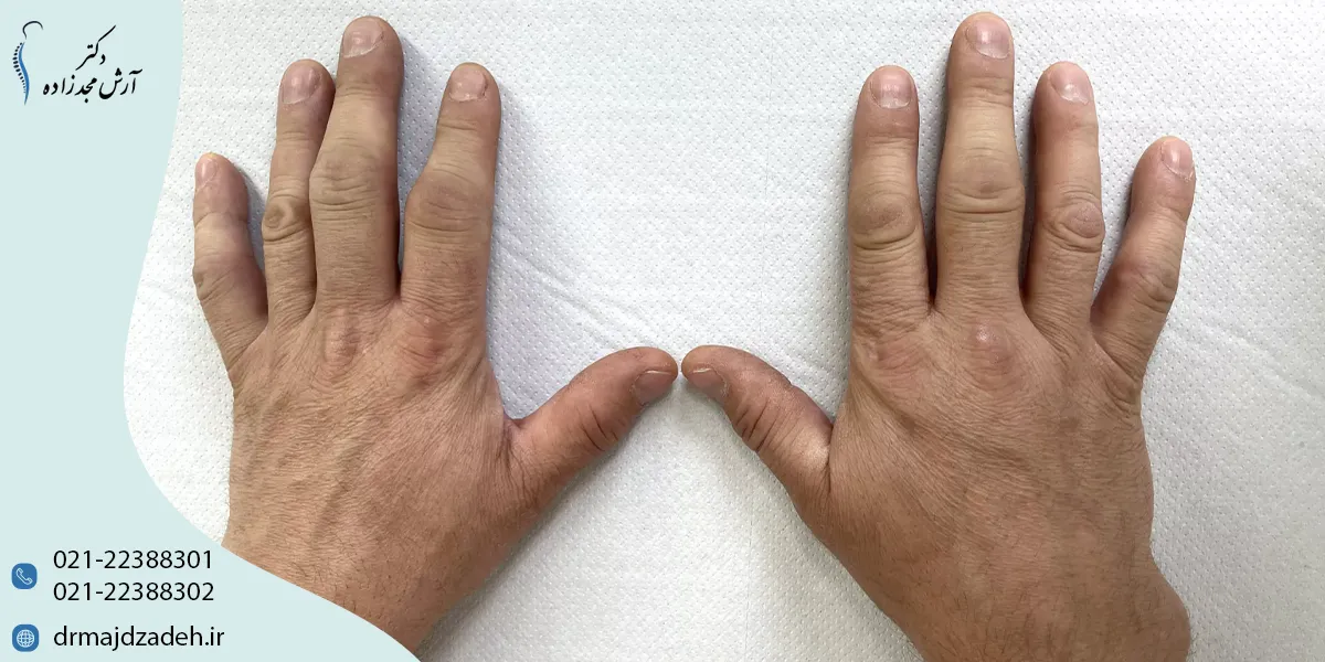 روشهای درمان روماتیسم مفصلی