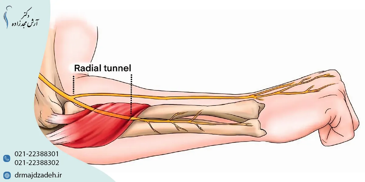 علت بیماری تنیس البو چیست؟