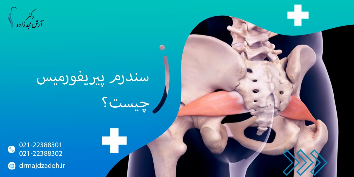 سندرم پیریفورمیس چیست؟