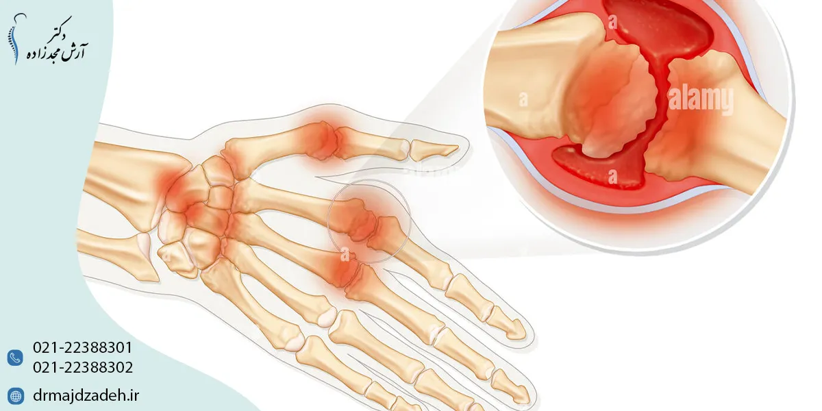 روماتیسم مفصلی چیست