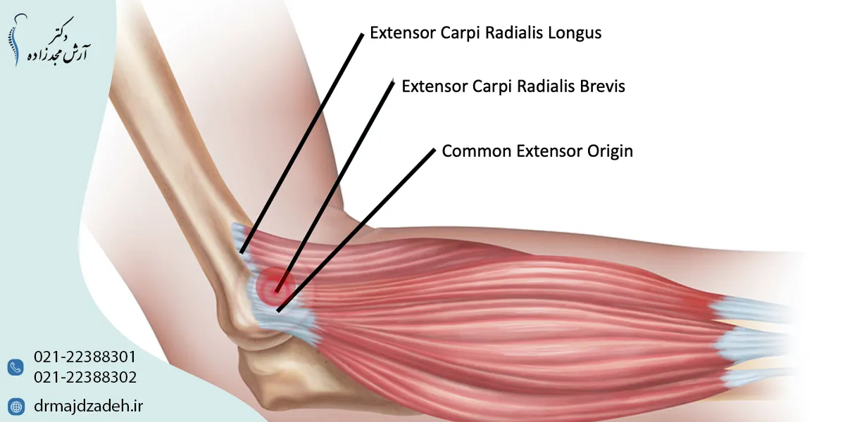 بیماری تنیس البو یا آرنج تنیس بازان چیست؟