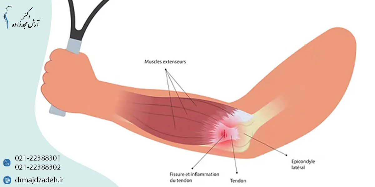 تفاوت تنیس البو با دردهای معمول آرنج چیست؟