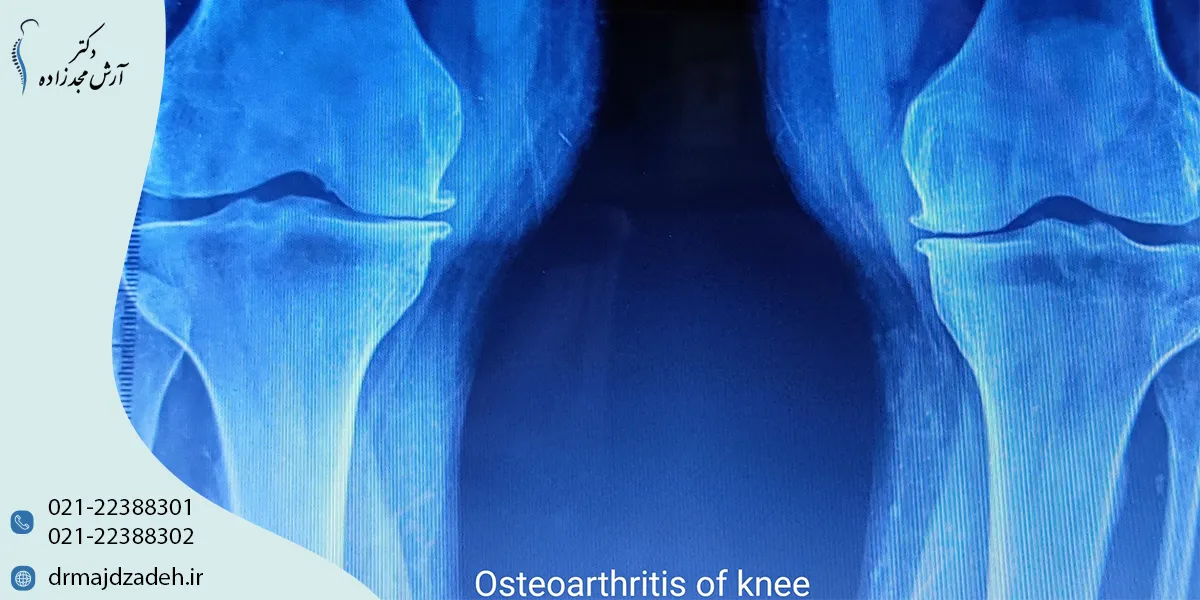 تشخیص آرتروز زانو