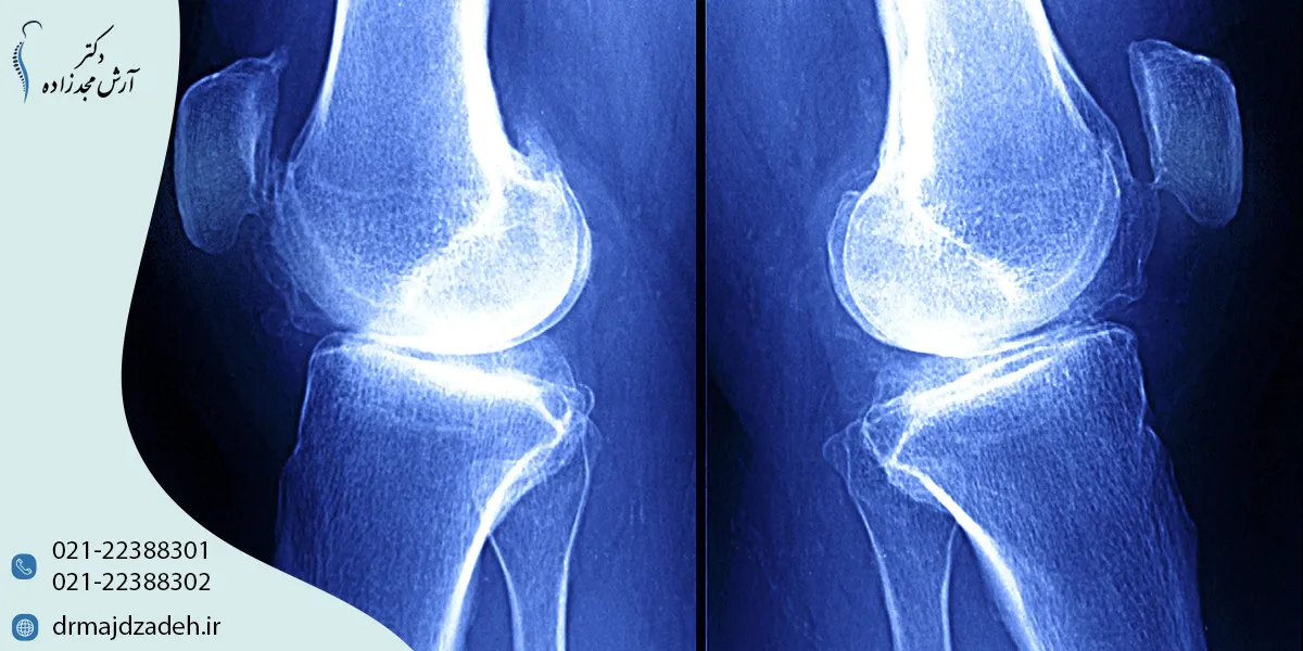 روش‌های پیشگیری از آرتروز زانو