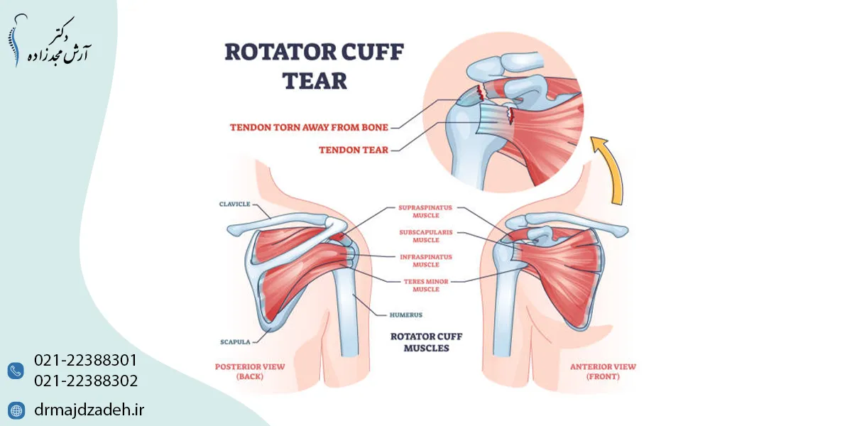 مراقبت های پس از درمان پارگی تاندون شانه