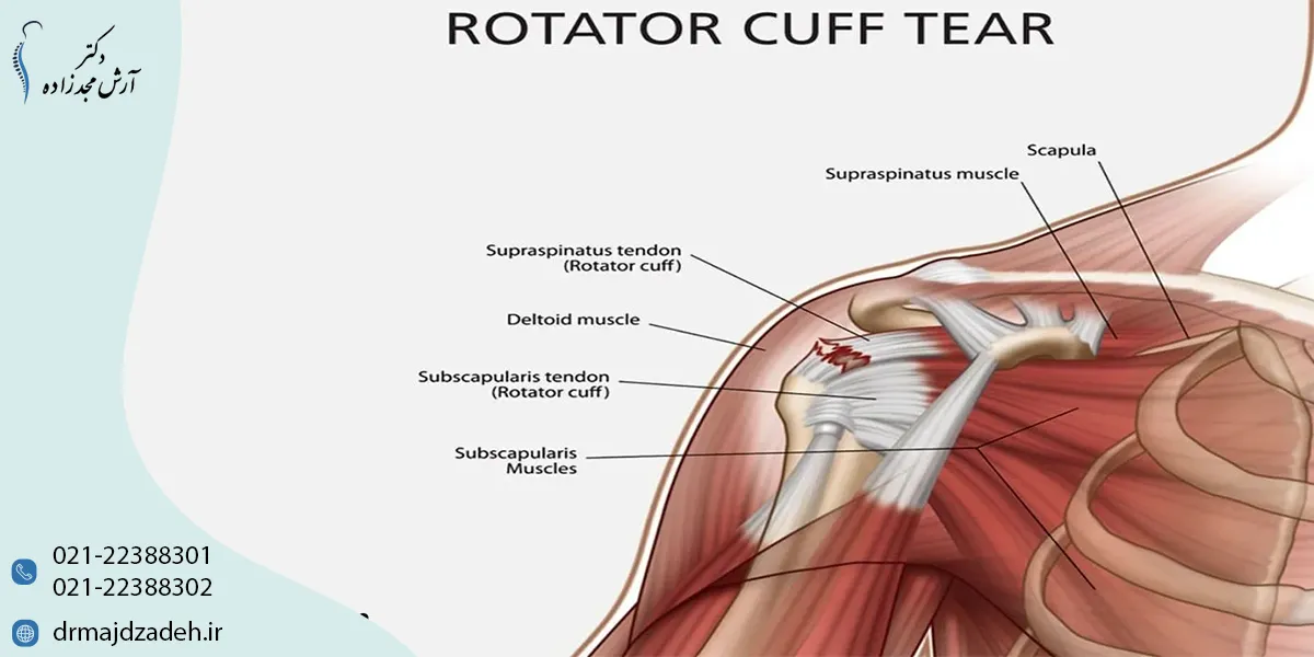 روش های درمان پارگی تاندون شانه