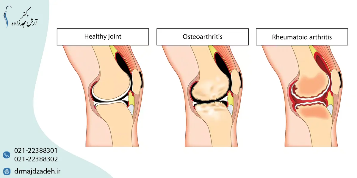 علائم آرتروز زانو چیست
