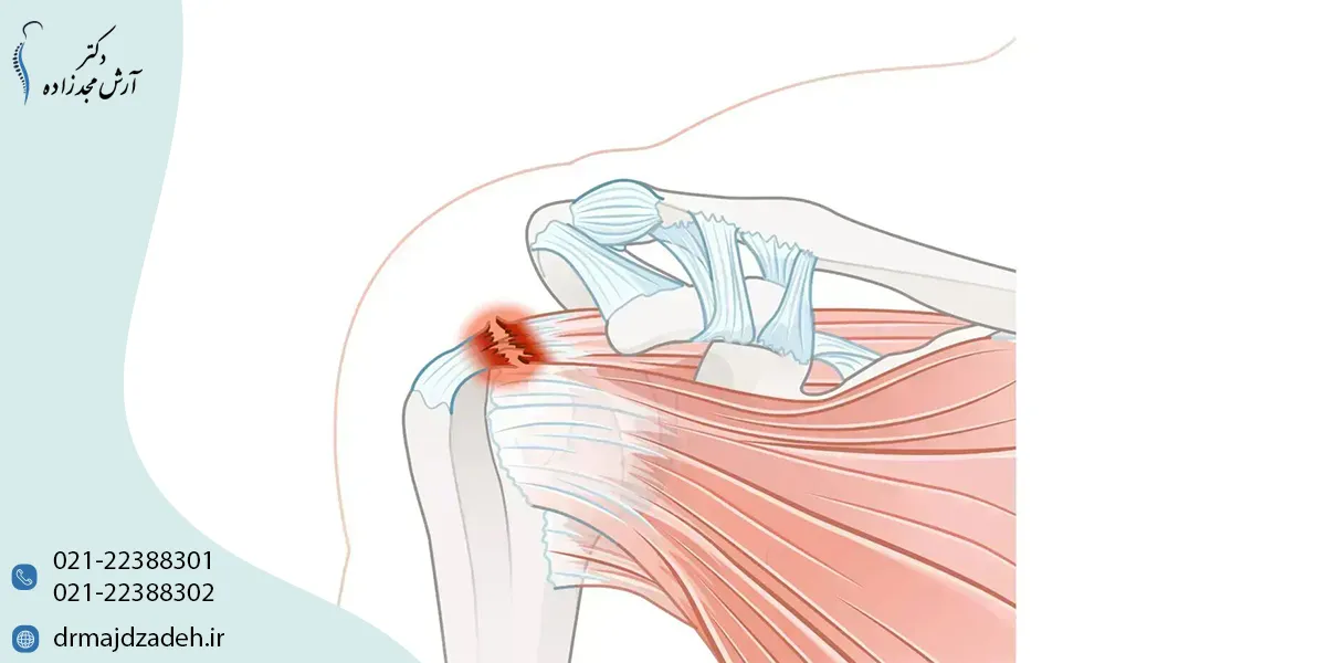 پارگی تاندون شانه چیست