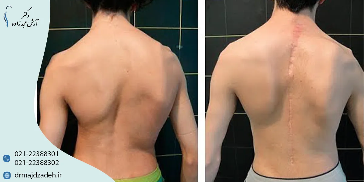 مراحل عمل اسکولیوز و مدت زمان جراحی