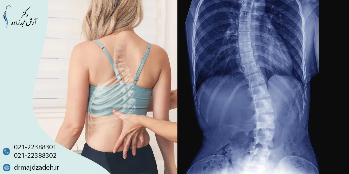 کاربرد طب سوزنی و سلولدرمانی در بهبود اسکولیوز