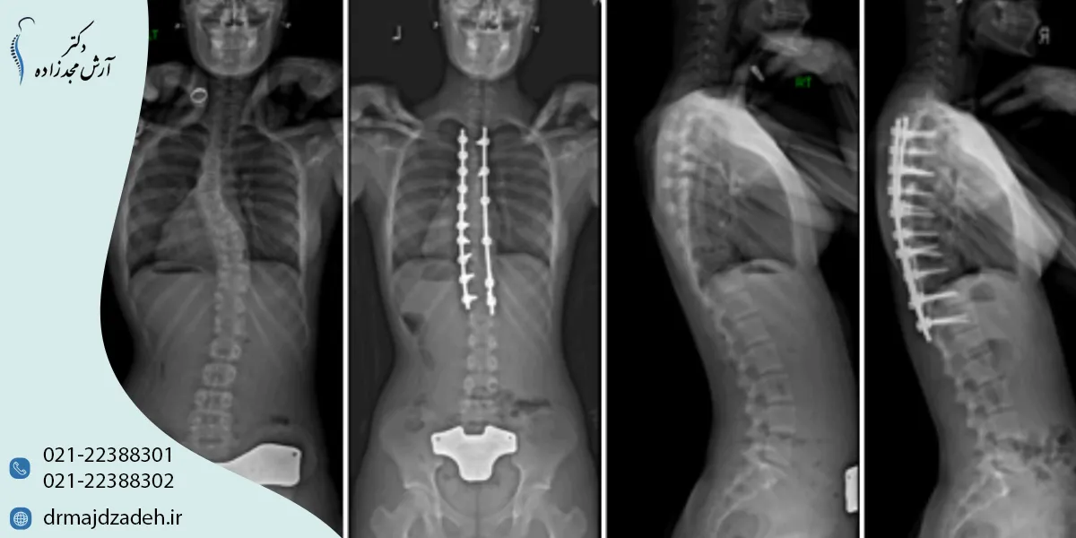 اسکولیوز چیست و چه علائمی دارد؟