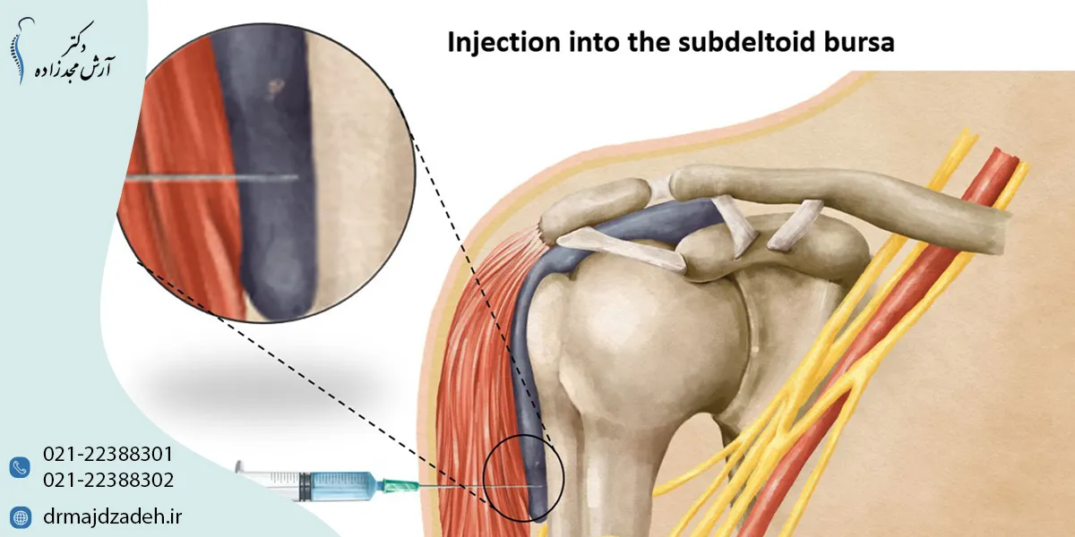 تزریق سلول بنیادی به شانه برای درمان چه مشکلاتی به کار میرود؟