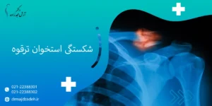 شکستگی استخوان ترقوه